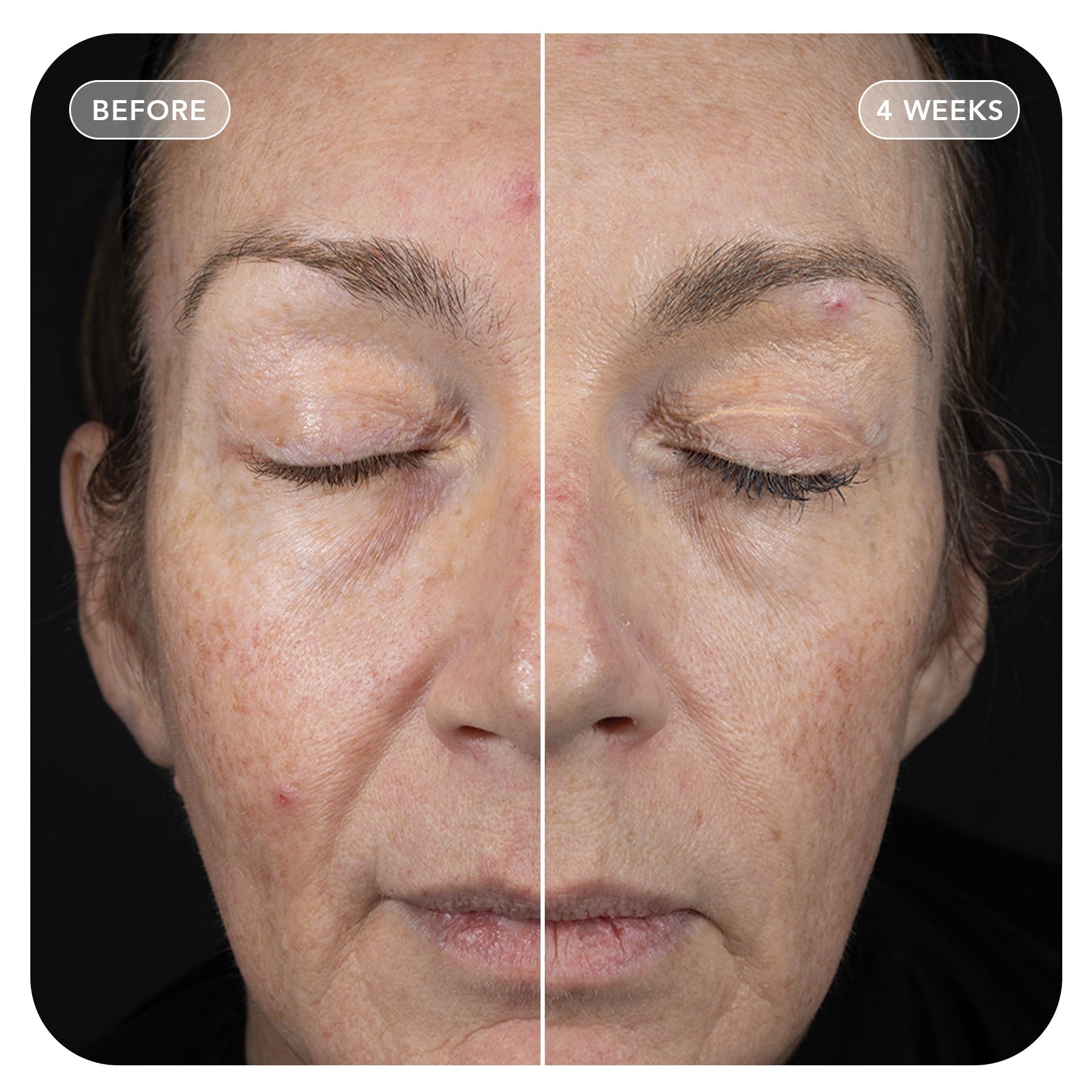 VOL.U.LIFT™ GLP-1 4D Skin Rebound Complex (3-pack)