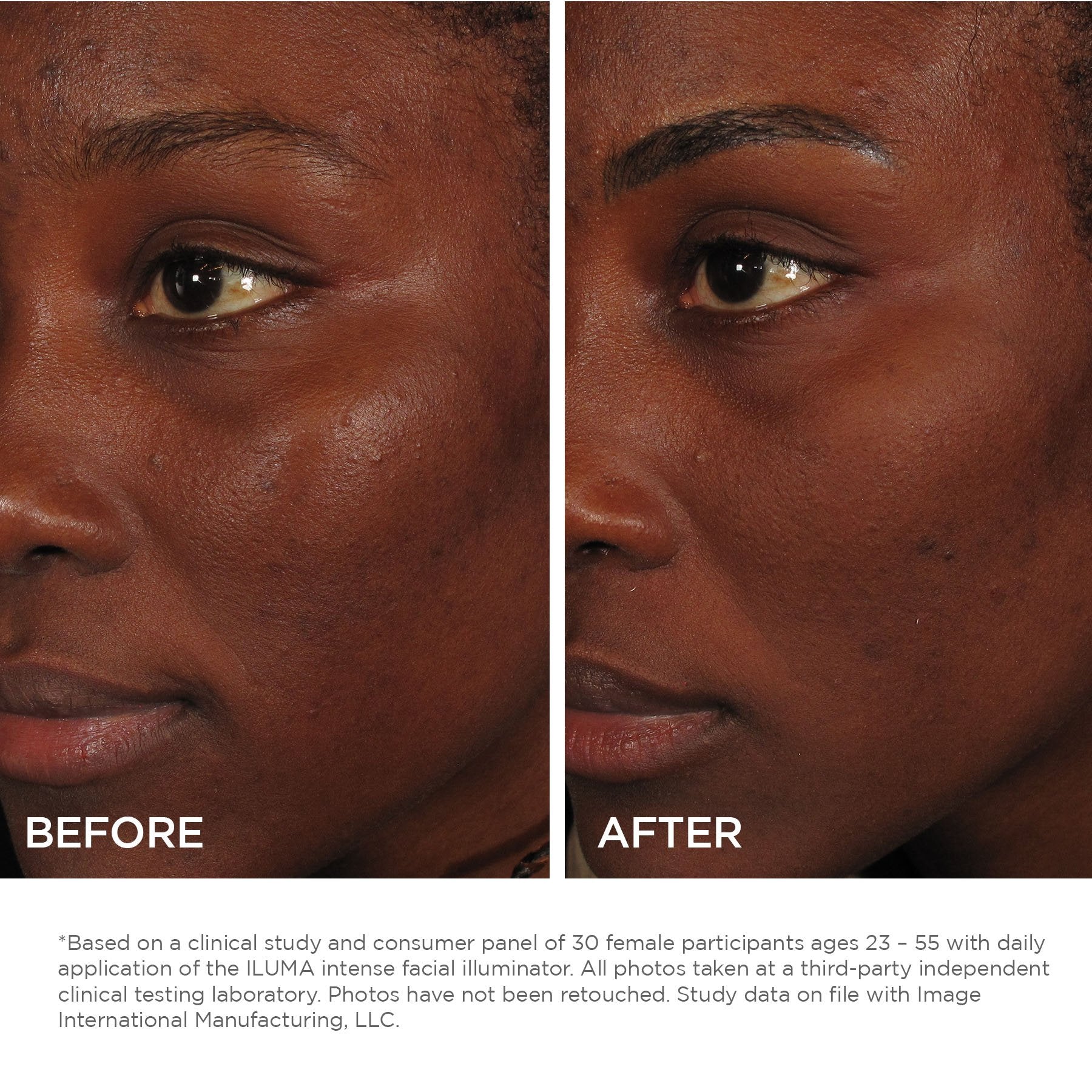 ILUMA® intense facial illuminator (samples 5-pack)